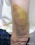 bruise 1.jpg